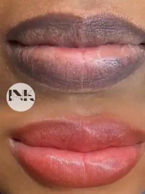 Lip neutralization correction treatment Lakeland Florida