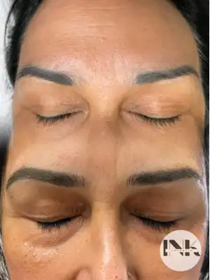 Brow Correction Lakeland before and after