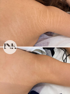 Stretch Mark Camouflage Tattoo results Lakeland
