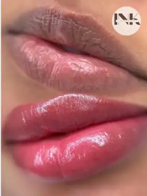 Lip neutralization Lakeland FL transformation